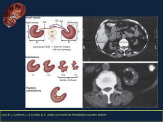 Nefritis Intersticial. Obed Rubio