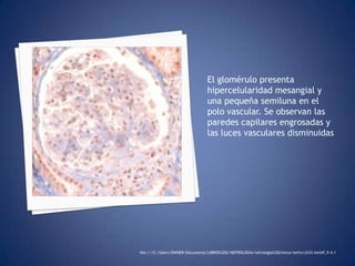 El glomérulo presenta hipercelularidadmesangial y una pequeña semiluna en el polo vascular. Se observan las paredes capilares engrosadas y las luces vasculares disminuidasfile:///C:/Users/OWNER/Documents/LIBROS%202/NEFROLOGIA/nefrologia%20clinica/nefro/ch33.htm#f_9.4.1