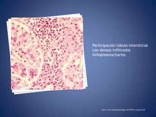 Participación túbulo-intersticial con densos infiltrados linfoplasmocitarioshttp://www.kidneypathology.com/Nefriris_lupica.html