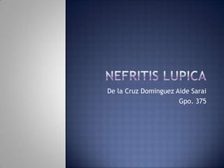 NEFRITIS LUPICA De la Cruz Dominguez Aide Sarai Gpo. 375 