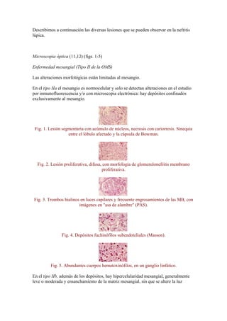 Describimos a continuación las diversas lesiones que se pueden observar en la nefritis
lúpica.



Microscopia óptica (11,12) (figs. 1-5)

Enfermedad mesangial (Tipo II de la OMS)

Las alteraciones morfológicas están limitadas al mesangio.

En el tipo IIa el mesangio es normocelular y solo se detectan alteraciones en el estudio
por inmunofluorescencia y/o con microscopia electrónica: hay depósitos confinados
exclusivamente al mesangio.




 Fig. 1. Lesión segmentaria con acúmulo de núcleos, necrosis con cariorresis. Sinequia
                   entre el lóbulo afectado y la cápsula de Bowman.




  Fig. 2. Lesión proliferativa, difusa, con morfología de glomerulonefritis membrano
                                       proliferativa.




Fig. 3. Trombos hialinos en luces capilares y frecuente engrosamientos de las MB, con
                        imágenes en "asa de alambre" (PAS).




                Fig. 4. Depósitos fuchinófilos subendoteliales (Masson).




          Fig. 5. Abundantes cuerpos hematoxinófilos, en un ganglio linfático.

En el tipo IIb, además de los depósitos, hay hipercelularidad mesangial, generalmente
leve o moderada y ensanchamiento de la matriz mesangial, sin que se altere la luz
 