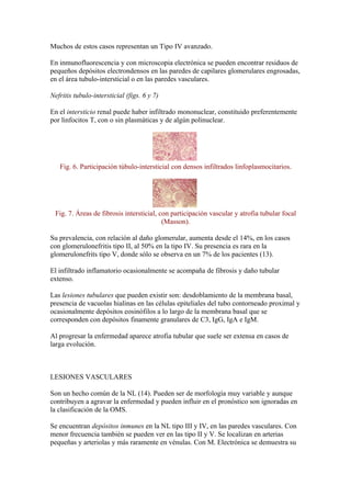 Muchos de estos casos representan un Tipo IV avanzado.

En inmunofluorescencia y con microscopia electrónica se pueden encontrar residuos de
pequeños depósitos electrondensos en las paredes de capilares glomerulares engrosadas,
en el área tubulo-intersticial o en las paredes vasculares.

Nefritis tubulo-intersticial (figs. 6 y 7)

En el intersticio renal puede haber infiltrado mononuclear, constituido preferentemente
por linfocitos T, con o sin plasmáticas y de algún polinuclear.




   Fig. 6. Participación túbulo-intersticial con densos infiltrados linfoplasmocitarios.




 Fig. 7. Áreas de fibrosis intersticial, con participación vascular y atrofia tubular focal
                                          (Masson).

Su prevalencia, con relación al daño glomerular, aumenta desde el 14%, en los casos
con glomerulonefritis tipo II, al 50% en la tipo IV. Su presencia es rara en la
glomerulonefrits tipo V, donde sólo se observa en un 7% de los pacientes (13).

El infiltrado inflamatorio ocasionalmente se acompaña de fibrosis y daño tubular
extenso.

Las lesiones tubulares que pueden existir son: desdoblamiento de la membrana basal,
presencia de vacuolas hialinas en las células epiteliales del tubo contorneado proximal y
ocasionalmente depósitos eosinófilos a lo largo de la membrana basal que se
corresponden con depósitos finamente granulares de C3, IgG, IgA e IgM.

Al progresar la enfermedad aparece atrofia tubular que suele ser extensa en casos de
larga evolución.



LESIONES VASCULARES

Son un hecho común de la NL (14). Pueden ser de morfología muy variable y aunque
contribuyen a agravar la enfermedad y pueden influir en el pronóstico son ignoradas en
la clasificación de la OMS.

Se encuentran depósitos inmunes en la NL tipo III y IV, en las paredes vasculares. Con
menor frecuencia también se pueden ver en las tipo II y V. Se localizan en arterias
pequeñas y arteriolas y más raramente en vénulas. Con M. Electrónica se demuestra su
 