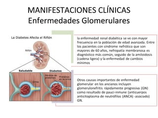 MANIFESTACIONES CLÍNICAS
Enfermedades Glomerulares
 