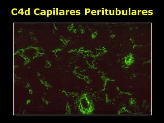 C4d Capilares Peritubulares 