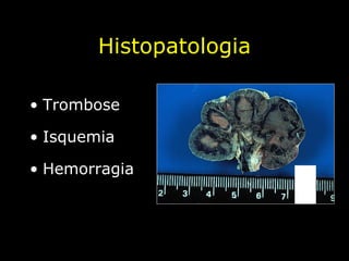 Histopatologia Trombose Isquemia  Hemorragia  