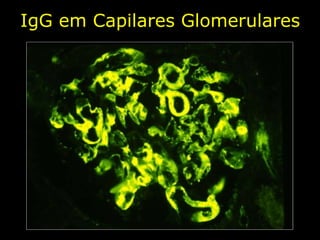 IgG em Capilares Glomerulares 