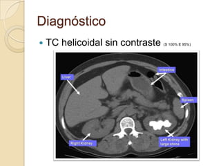 Diagnóstico
   TC helicoidal sin contraste   (S 100% E 95%)
 