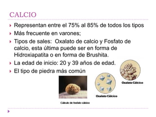 CALCIO
   Representan entre el 75% al 85% de todos los tipos
   Más frecuente en varones;
   Tipos de sales: Oxalato de calcio y Fosfato de
    calcio, esta última puede ser en forma de
    Hidroxiapatita o en forma de Brushita.
   La edad de inicio: 20 y 39 años de edad.
   El tipo de piedra más común
 