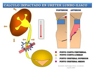 ANTERIORPOSTERIOR
PUNTO COSTO-VERTEBRAL
PUNTO COSTO-LUMBAR
PUNTO URETERAL SUPERIOR
PUNTO URETERAL MEDIO
CALCULO IMPACTADO EN URETER LUMBO-ILIACO
Avendaño. Nefrología Clínica. 2a Edición,
España 2003
 