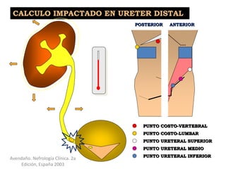 ANTERIORPOSTERIOR
PUNTO COSTO-VERTEBRAL
PUNTO COSTO-LUMBAR
PUNTO URETERAL SUPERIOR
PUNTO URETERAL MEDIO
PUNTO URETERAL INFERIOR
CALCULO IMPACTADO EN URETER DISTAL
Avendaño. Nefrología Clínica. 2a
Edición, España 2003
 