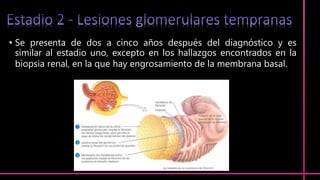 • Se presenta de dos a cinco años después del diagnóstico y es
similar al estadio uno, excepto en los hallazgos encontrados en la
biopsia renal, en la que hay engrosamiento de la membrana basal.
 