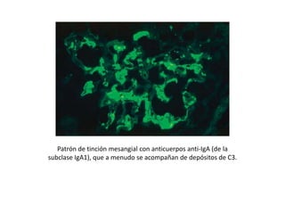 Patrón de tinción mesangial con anticuerpos anti-IgA (de la
subclase IgA1), que a menudo se acompañan de depósitos de C3.
 