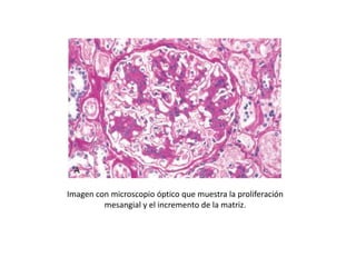 Imagen con microscopio óptico que muestra la proliferación
mesangial y el incremento de la matriz.
 