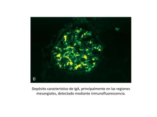 Depósito característico de IgA, principalmente en las regiones
mesangiales, detectado mediante inmunofluorescencia.
 