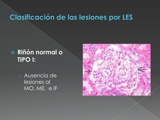    Riñón normal o
    TIPO I:

    › Ausencia de
      lesiones al
      MO, ME, e IF
 