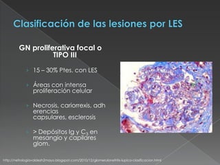 GN proliferativa focal o
                   TIPO III

             › 15 – 30% Ptes. con LES

             › Áreas con intensa
                 proliferación celular

             › Necrosis, cariorrexis, adh
                 erencias
                 capsulares, esclerosis

             › > Depósitos Ig y C3 en
                 mesangio y capilares
                 glom.

http://nefrologiavaldezh2mayo.blogspot.com/2010/12/glomerulonefritis-lupica-clasificacion.html
 