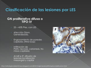 GN proliferativa difusa o
                  TIPO IV
             › 25 – 45% Ptes. con LES

             › Afección Glom.
                 Generalizada,

             › Engrosamiento de paredes
                 capilares (Wire-loop)

             › Infiltración de
                 PMN, necrosis, cariorrexis, tro
                 mbos capilares

             › Al ME e IF: difusión de
                 lesiones localización
                 mesangial y capilar

http://nefrologiavaldezh2mayo.blogspot.com/2010/12/glomerulonefritis-lupica-clasificacion.html
 