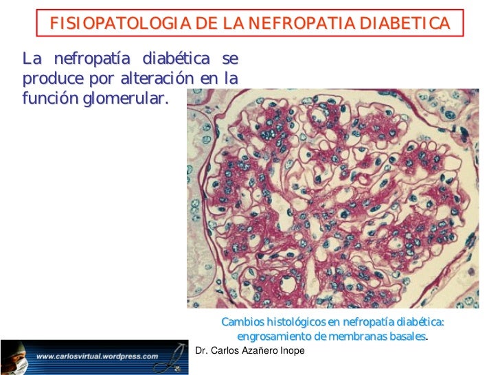 Nefropatia diabetica