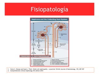 Fisiopatología
1. Claire C. Sharpe and Swee L. Thein. Sickle cell nephropathy – a practical British Journal of Haematology, 155, 287–297
2. Comprenhensive clinical nephrology 4th edition 2010
Hipoxia relativa, acidosis e hiperosmolaridad
 