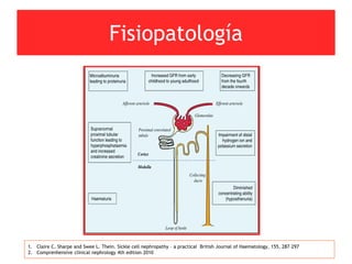 Fisiopatología
1. Claire C. Sharpe and Swee L. Thein. Sickle cell nephropathy – a practical British Journal of Haematology, 155, 287–297
2. Comprenhensive clinical nephrology 4th edition 2010
 