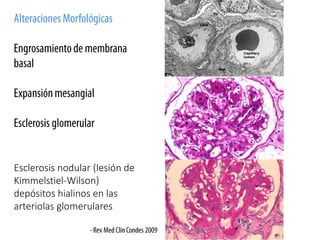 Esclerosis nodular (lesión de
Kimmelstiel-Wilson)
depósitos hialinos en las
arteriolas glomerulares
 