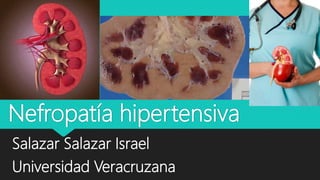 Nefropatía hipertensiva
Salazar Salazar Israel
Universidad Veracruzana
 