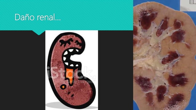 Nefropatia hipertensiva, nefroesclerosis