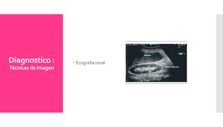 Diagnostico :
Técnicas de imagen
 Ecografía renal
 