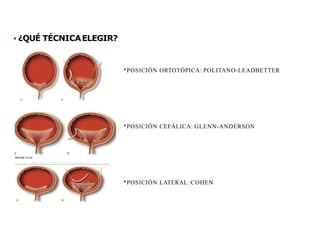  ¿QUÉ TÉCNICAELEGIR?
*POSICIÓN ORTOTÓPICA: POLITANO-LEADBETTER
*POSICIÓN CEFÁLICA: GLENN-ANDERSON
*POSICIÓN LATERAL :COHEN
 