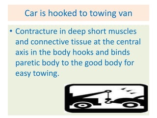 Car is hooked to towing van
• Contracture in deep short muscles
  and connective tissue at the central
  axis in the body hooks and binds
  paretic body to the good body for
  easy towing.
 