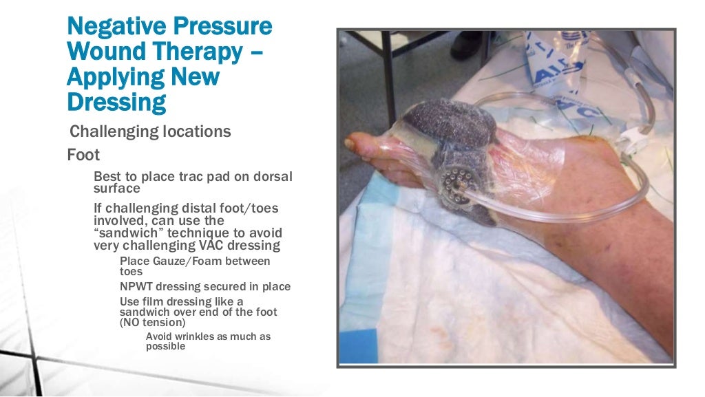 Negative pressure wound therapy