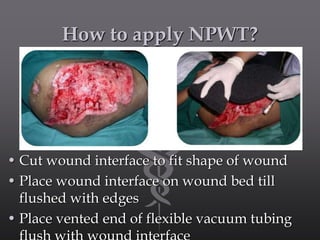 How to apply NPWT?
• Cut wound interface to fit shape of wound
• Place wound interface on wound bed till
flushed with edges
• Place vented end of flexible vacuum tubing
 