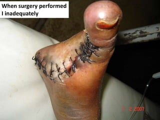 When surgery performed
I inadequately
 