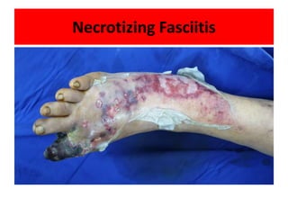 Necrotizing Fasciitis
 
