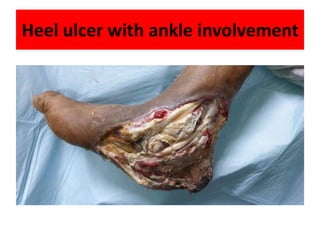 Heel ulcer with ankle involvement
 