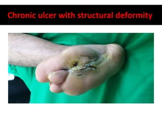 Chronic ulcer with structural deformity
 