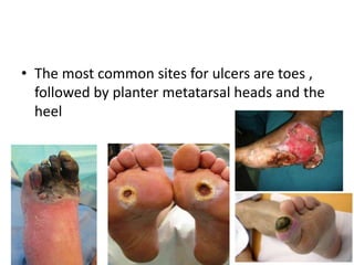 • The most common sites for ulcers are toes ,
followed by planter metatarsal heads and the
heel
 