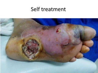 Neglected Diabetic Foot.pptx