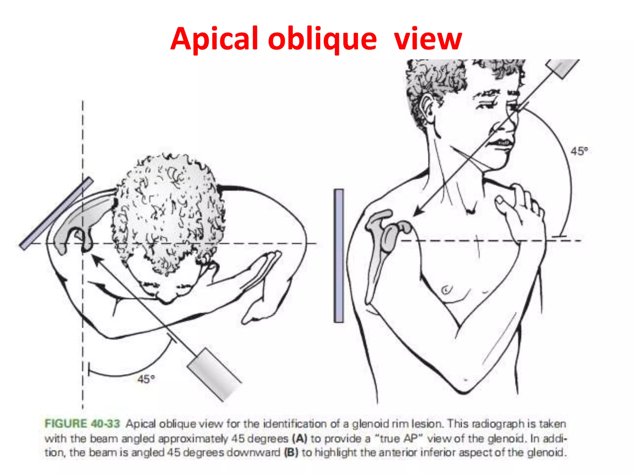 Shoulder Method Rizz Neglected shoulder dislocation management | PPTX