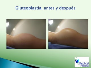 En una sola sesión.