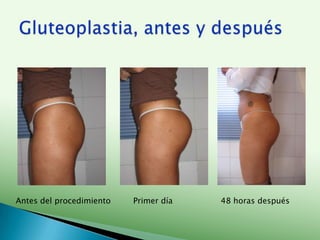 De larga duración.Gluteoplastia con ácido hialurónico