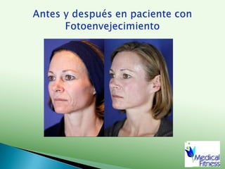 Gluteoplastia, antes y después