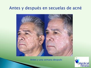 Gluteoplastia, antes y después