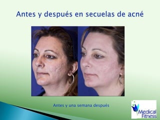 Gluteoplastia, antes y despuésAntes del procedimientoPrimer día48 horas después