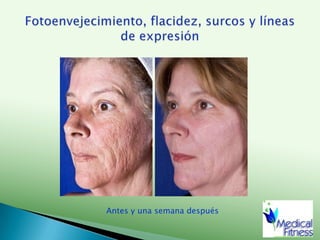 Gluteoplastia, antes y despuésAntes del procedimientoPrimer día48 horas después