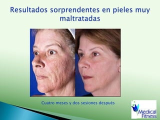 Indicaciones:FotoenvejecimientoArrugas y manchas ocasionadas por el solFlacidezCicatrices de acnéLáser de CO2 microfraccionado rejuvenecimiento facial con resultados increíbles en una sola sesión!!