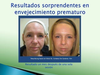 Antes y después en paciente con Fotoenvejecimiento