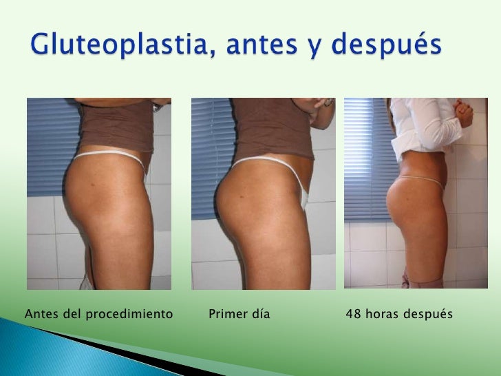 Operación Glúteos Antes Y Después Negocios Medical Fitness