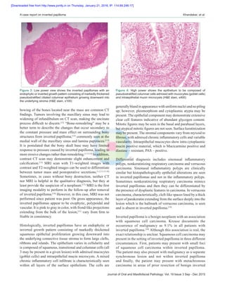 Journal of Oral and Maxillofacial Pathology: Vol. 19 Issue 3 Sep ‑ Dec 2015
A case report on inverted papilloma  Khandekar, et al.
bowing of the bones located near the mass are common CT
findings. Tumors involving the maxillary sinus may lead to
widening of infundibulum on CT scan, making the uncinate
process difficult to discern.[12]
“Bone‑remodeling” may be a
better term to describe the changes that occur secondary to
the constant pressure and mass effect on surrounding bony
structures from inverted papilloma,[13]
commonly seen at the
medial wall of the maxillary sinus and lamina papyracea.[1,8]
It is postulated that the bony skull base may have limited
response to pressure caused by inverted papilloma, leading to
more erosive changes rather than remodeling.[1,13,14]
In addition,
contrast CT scan may demonstrate slight enhancement and
calcification.[13]
MRI scan with T1‑weighted images with
contrast and T2‑weighted images can be used to differentiate
between tumor mass and postoperative secretions.[1,2,13,15,16]
Sometimes, in cases without bony destruction, neither CT
nor MRI is helpful in the qualitative diagnosis, but they at
least provide the suspicion of a neoplasm.[17]
MRI is the first
imaging modality to perform in the follow‑up after removal
of inverted papilloma.[18]
However, in this case, MRI was not
performed since patient was poor. On gross appearance, the
inverted papillomas appear to be exophytic, polypoidal and
vascular. It is pink to gray in color, with frond‑like projections
extending from the bulk of the lesion,[11]
vary from firm to
friable in consistency.
Histologically, inverted papillomas have an endophytic or
inverted growth pattern consisting of markedly thickened
squamous epithelial proliferation growing downward into
the underlying connective tissue stroma to form large clefts,
ribbons and islands. The epithelium varies in cellularity and
is composed of squamous, transitional and columnar cells (all
3 may be present in a given lesion) with admixed mucocytes
(goblet cells) and intraepithelial mucin microcysts. A mixed
chronic inflammatory cell infiltrate is characteristically seen
within all layers of the surface epithelium. The cells are
generallyblandinappearancewithuniformnucleiandnopiling
up; however, pleomorphism and cytoplasmic atypia may be
present. The epithelial component may demonstrate extensive
clear cell features indicative of abundant glycogen content.
Mitotic figures may be seen in the basal and parabasal layers,
but atypical mitotic figures are not seen. Surface keratinization
may be present. The stromal components vary from myxoid to
fibrous, with admixed chronic inflammatory cells and variable
vascularity. Intraepithelial mucocytes show intra cytoplasmic
mucin positive material, which is Mucicarmine positive and
diastase – resistant, PAS – positive.
Differential diagnosis includes sinonasal inflammatory
polyps, nonkeratinizing respiratory carcinoma and verrucous
carcinoma. Sinonasal inflammatory polyps are clinically
similar but histopathologically epithelial alterations are seen
in inverted papillomas and not in the inflammatory polyps.
Sometimes nonkeratinizing respiratory carcinoma mimics
inverted papillomas and then they can be differentiated by
the presence of dysplastic features in carcinoma. In verrucous
carcinoma, characteristically, cleft‑like spaces lined by a thick
layer of parakeratin extending from the surface deeply into the
lesion which is the hallmark of verrucous carcinoma, is seen
and is absent in inverted papilloma.[19]
Inverted papilloma is a benign neoplasm with an association
with squamous cell carcinoma. Krouse documents the
occurrence of malignancy as 9.1% in all patients with
inverted papilloma.[20]
Although this association is real, the
exact relationship is unclear. Squamous cell carcinoma may
present in the setting of inverted papilloma in three different
circumstances. First, patients may present with small foci
of squamous cell carcinoma within inverted papilloma.
The patient may also present with malignancy as a separate
synchronous lesion and not within inverted papilloma
and finally, the patient may present with metachronous
carcinoma in areas of prior resection of benign inverted
Figure 3: Low power view shows the inverted papillomas with an
endophytic or inverted growth pattern consisting of markedly thickened
pseudostratified ciliated columnar epithelium growing downward into
the underlying stroma (HE stain, x100)
Figure 4: High power shows the epithelium to be composed of
pseudostratified columnar cells admixed with mucocytes (goblet cells)
and intraepithelial mucin microcysts (HE stain, x400)
[Downloaded free from http://www.jomfp.in on Thursday, January 21, 2016, IP: 114.69.248.17]
 