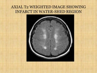 AXIAL T2 WEIGHTED IMAGE SHOWING
INFARCT IN WATER-SHED REGION
 